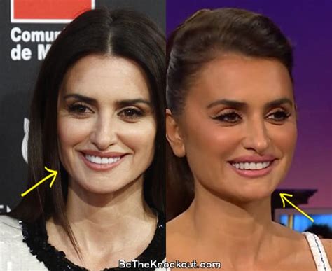 penelope cruz plastic surgery